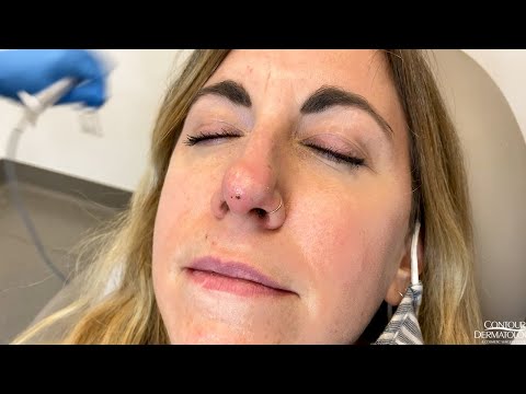 Removing a Small Bump on the Nose (Fibrous Papule)