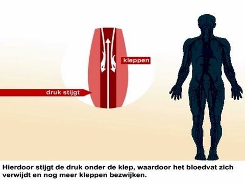 Spataderen - Klachten en verwijderen