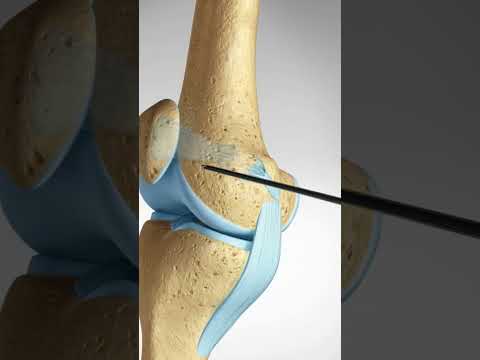 What Happens when You Dislocate Your Knee Cap (MPFL Tears and Reconstruction)