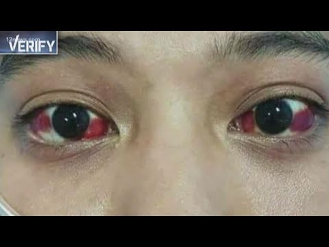 Verify: Can gaming cause blood vessels in your eyes to burst?